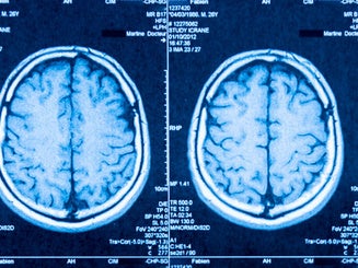 Three brain scans in medical imaging format. Blue tones highlight cerebral structures. No facial expressions or human emotions shown. Ideal for health, neuroscience, or medical education